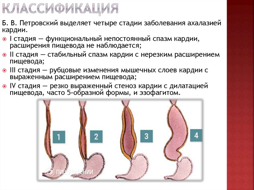 Пищевода 4 стадия. Ахалазия пищевода эндоскопическая классификация. Рентгенологическая классификация ахалазии пищевода. Ахалазия пищевода 1 ст рентген. Ахалазия пищевода 2 стадия.