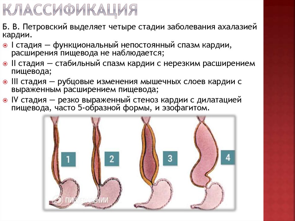 Эндоскопические признаки кардии. Ахалазия пищевода эндоскопическая классификация. Рентгенологическая классификация ахалазии пищевода. Ахалазия пищевода 1 ст рентген. Ахалазия пищевода 2 стадия.