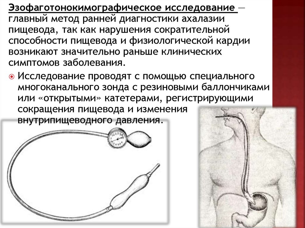 Схема ахалазия кардии