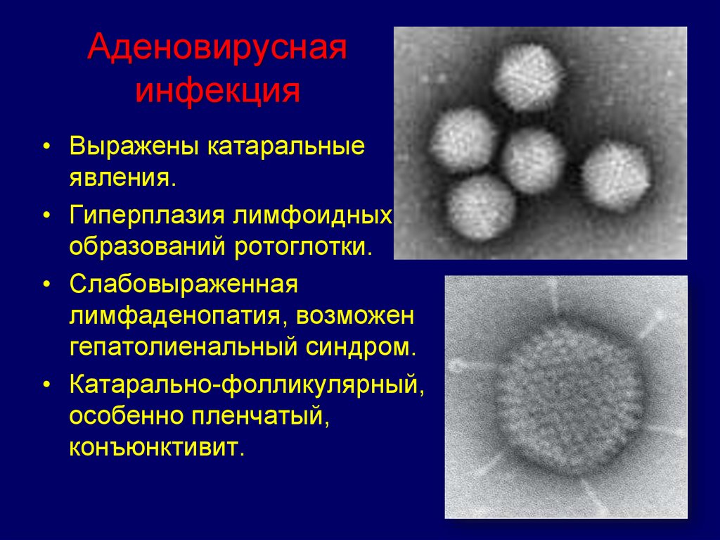 Катаральный грипп