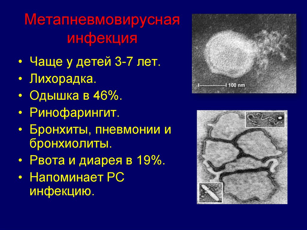 Метапневмовирус у ребенка