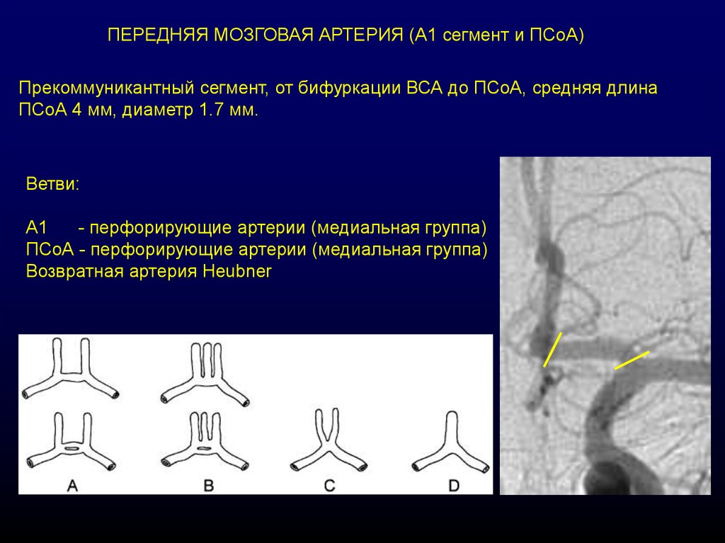 Сегмент а1 пма. Сегмент а2 ПМА. Сегменты передней мозговой артерии а1 а2. Передняя мозговая артерия сегмент а1. Сегменты артерий головного мозга анатомия.