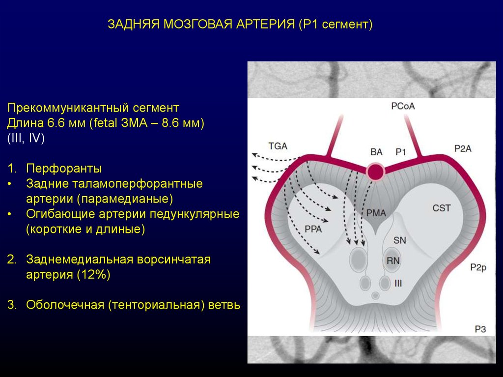 Артерии задних сегментов. Сегменты задней мозговой артерии. Р1 сегмент задней мозговой артерии. Сегменты артерий головного мозга. Задняя мозговая артерия анатомия сегменты.