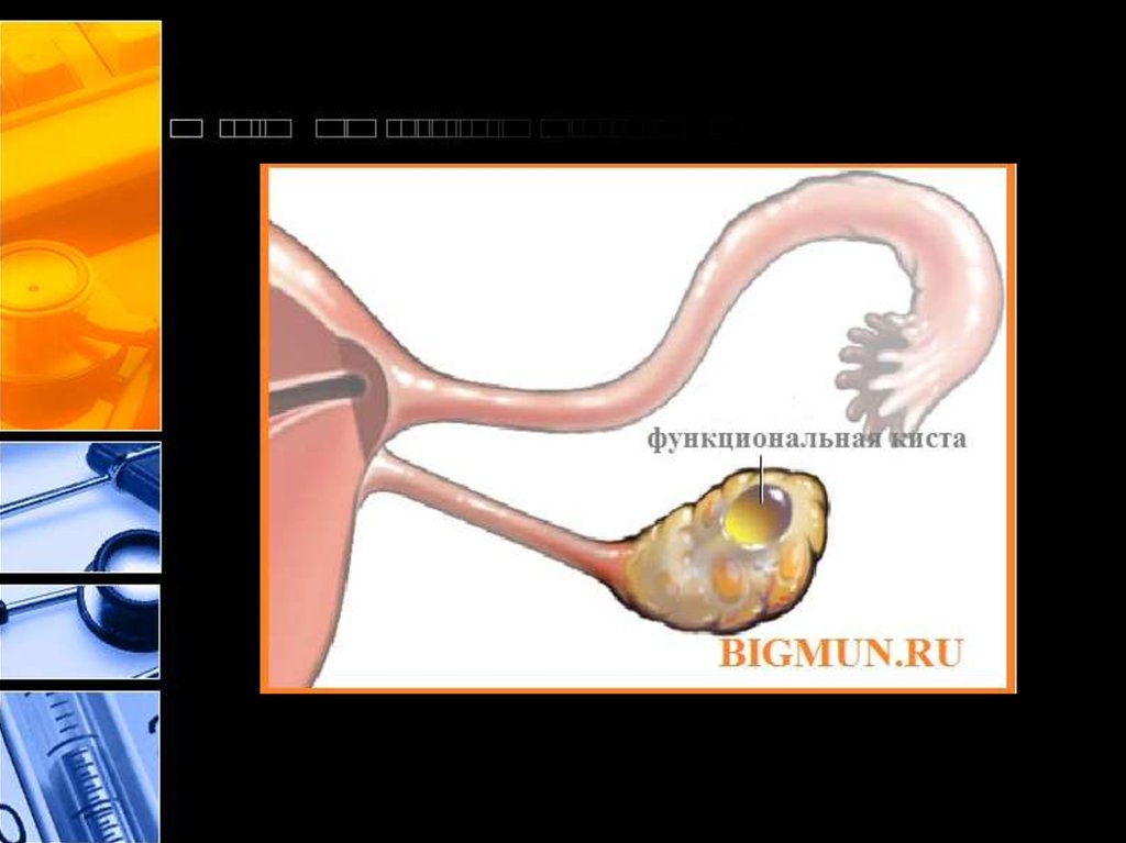 Функциональная киста яичника. Удаление кисты яичников в Бишкеке.