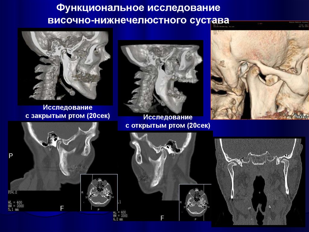 Височно нижнечелюстной сустав фото