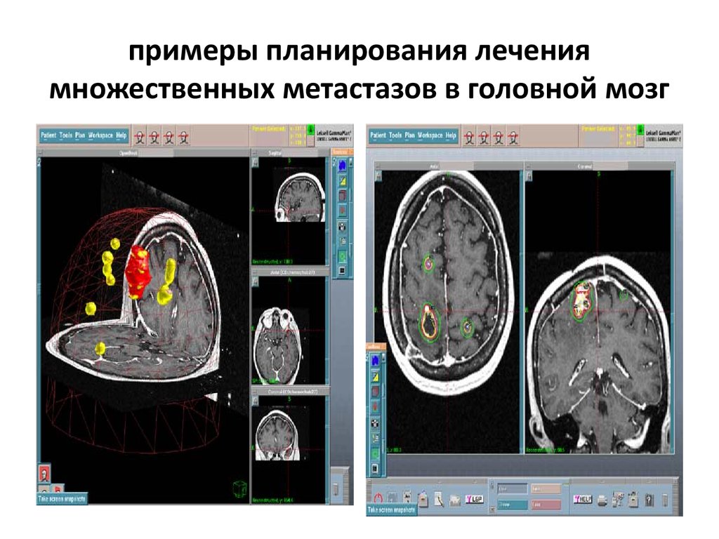 Метастазы в мозг прогноз. Множественные метастазы в мозге. Стереотаксическая радиохирургия. IMRT при множественных метастазах в головном мозге.