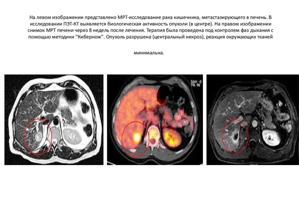 Кт отзывы врачей. Позитронно-эмиссионная томография метастазы. ПЭТ кт мрт. Питание перед ПЭТ кт исследование.