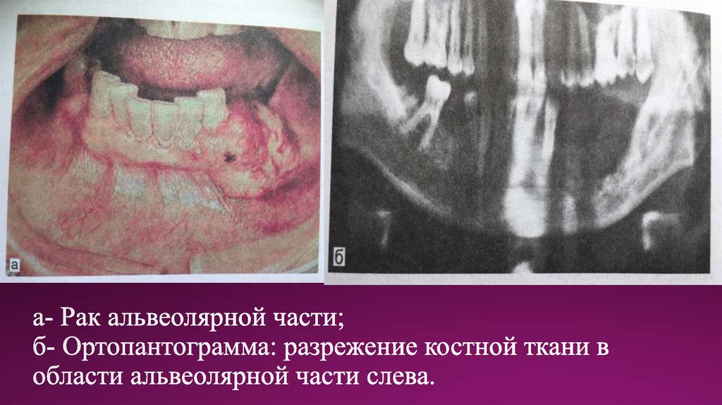 а- Рак альвеолярной части; б- Ортопантограмма: разрежение костной ткани в области альвеолярной части слева.