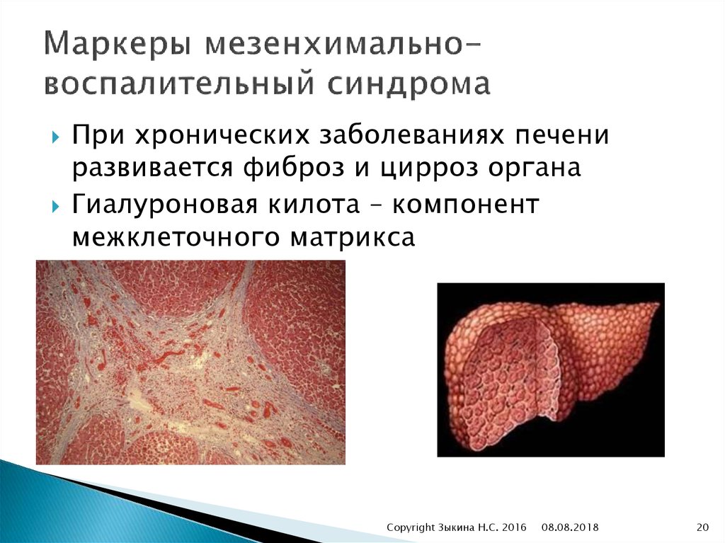 Маркеры мезенхимально-воспалительный синдрома