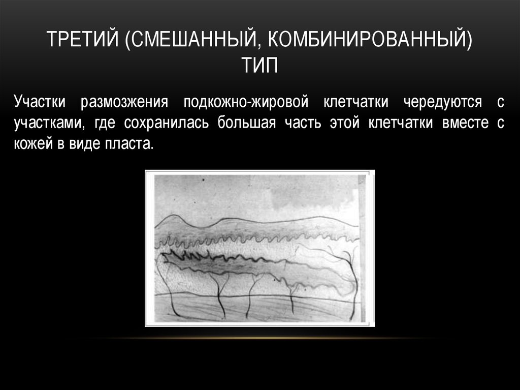 Третий (смешанный, комбинированный) тип