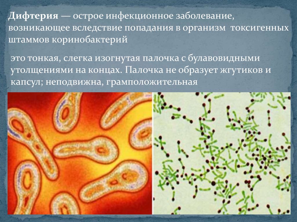 Передача возбудителя дифтерии возможна. Дифтерия острое инфекционное. Corynebacterium diphtheriae жгутики. Булавовидные бактерии. Дифтерия грамположительная палочка.