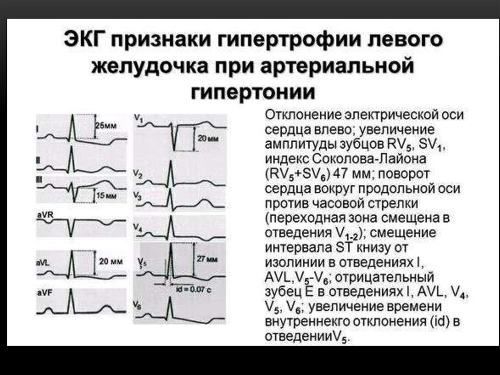 Глж сердца. Левожелудочковая гипертрофия ЭКГ. Гипертрофия миокарда лж на ЭКГ. Гипертрофия левого желудочка на ЭКГ. ЭКГ гипертоническая болезнь 2 стадия.