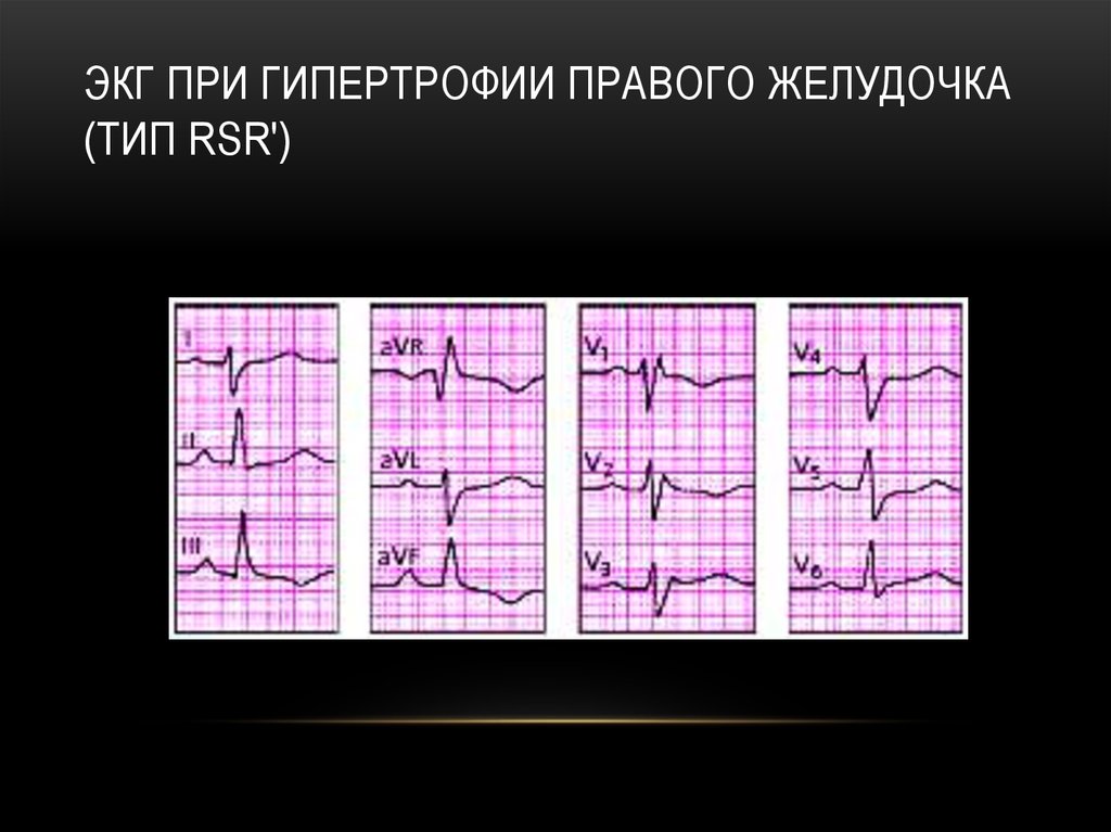 ЭКГ при гипертрофии правого желудочка (тип rSR')