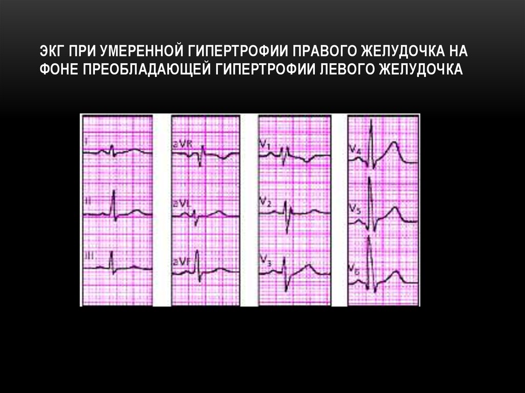 Гипертрофия левого желудочка фото