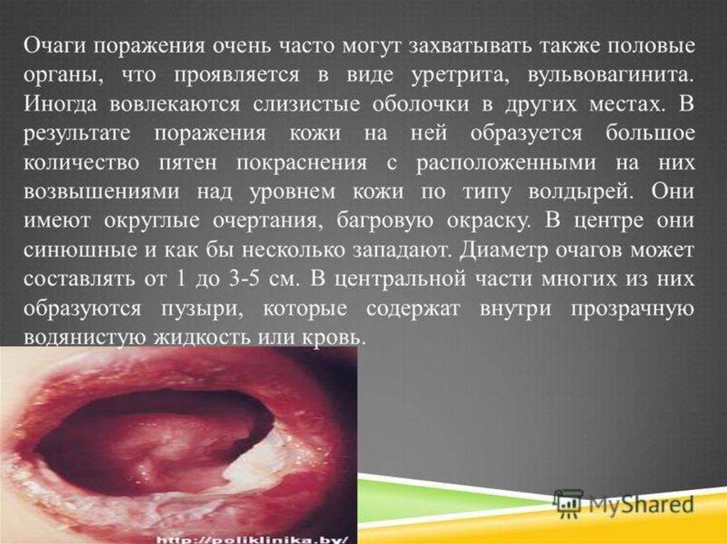 Синдромы Лайелла и Стивенса-Джонсона - презентация онлайн