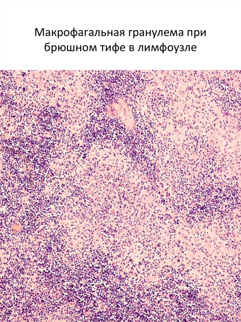 Брюшнотифозная гранулема. План обследования при брюшном тифе. Язык при брюшном тифе фото. Лимфоузел при брюшном тифе.