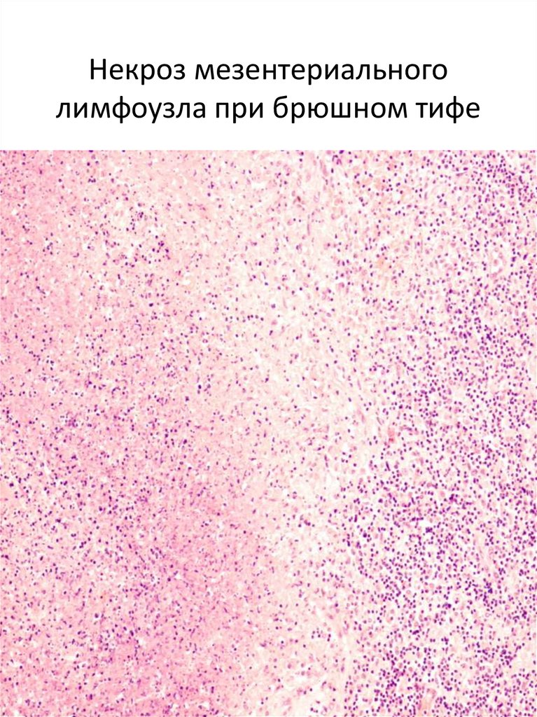 Пациентам с брюшным тифом при задержке стула