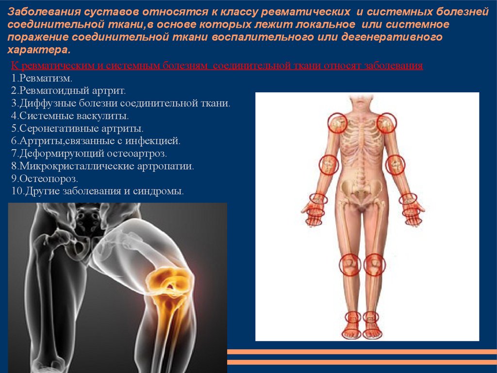 Какие заболевание суставов. Заболевания суставов и соединительной ткани. Болезнь соединительной ткани суставов. Системные заболевания поражающие суставы.