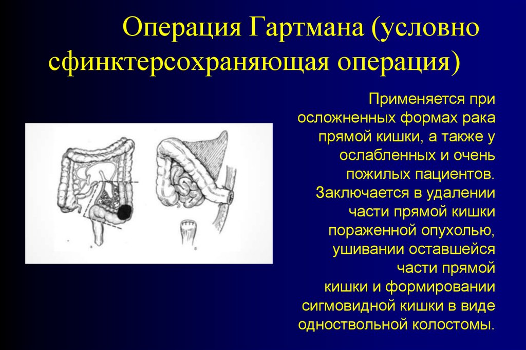 Схема операция гартмана