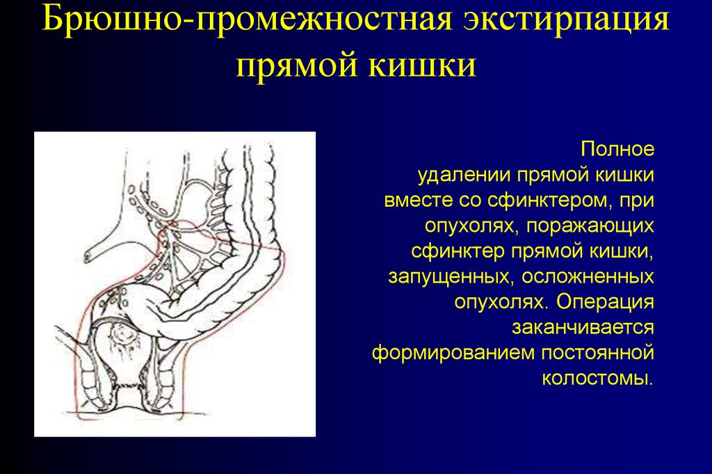 Облучение прямой кишки схема лечения