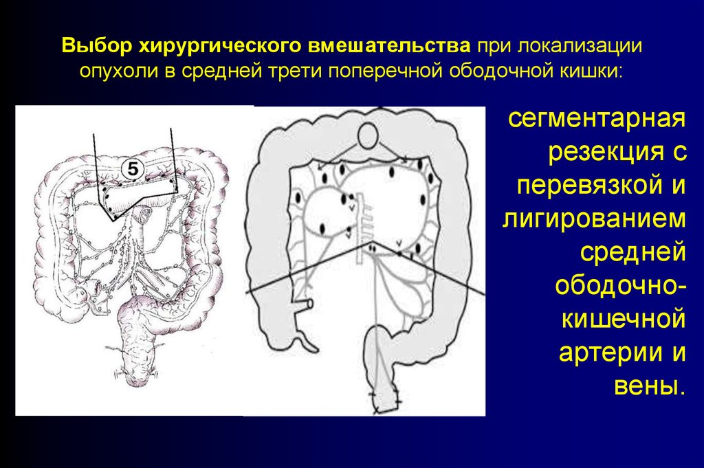 Поперечно ободочная кишка