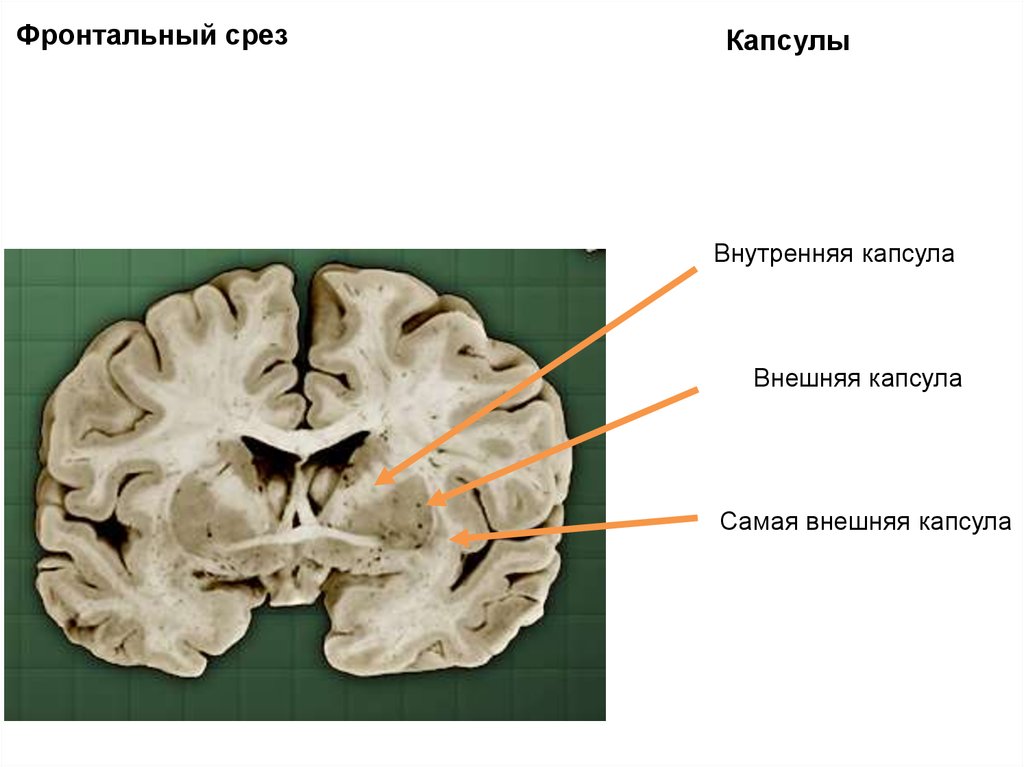 Мозг ленина. Внутренняя и наружная капсула. Внешняя капсула мозга. Внутренняя капсула наружная капсула. Самая наружная капсула мозга.