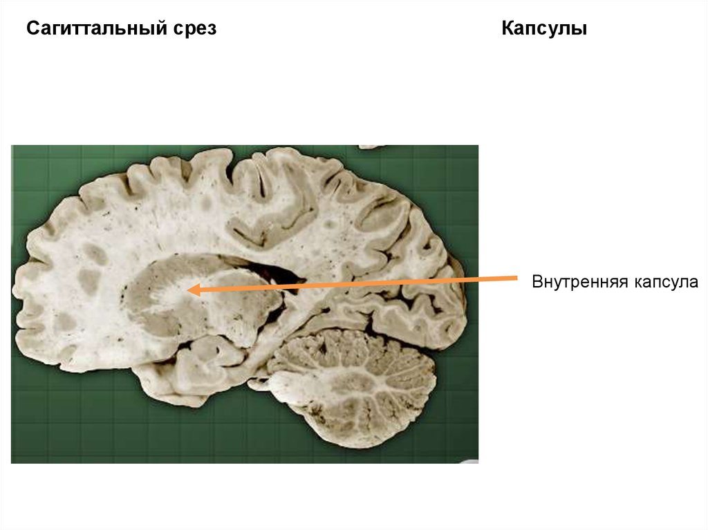 Временной срез. Сагиттальный срез. Сагиттальный срез мозга. Сагиттальный срез головы. Внутренняя капсула.