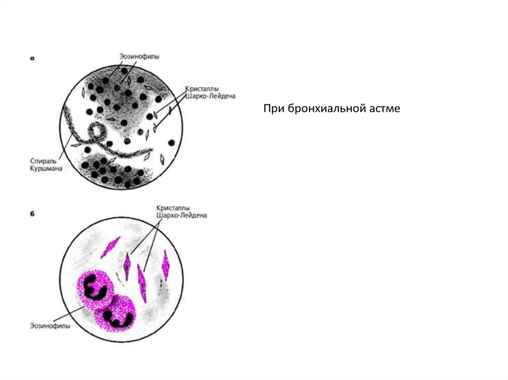 Эозинофилы 0. Спирали Куршмана и Кристаллы Шарко-Лейдена в мокроте. Кристаллы Шарко-Лейдена в мокроте. Лабораторное исследование мокроты при бронхиальной астме. Спирали Куршмана Кристаллы Шарко.