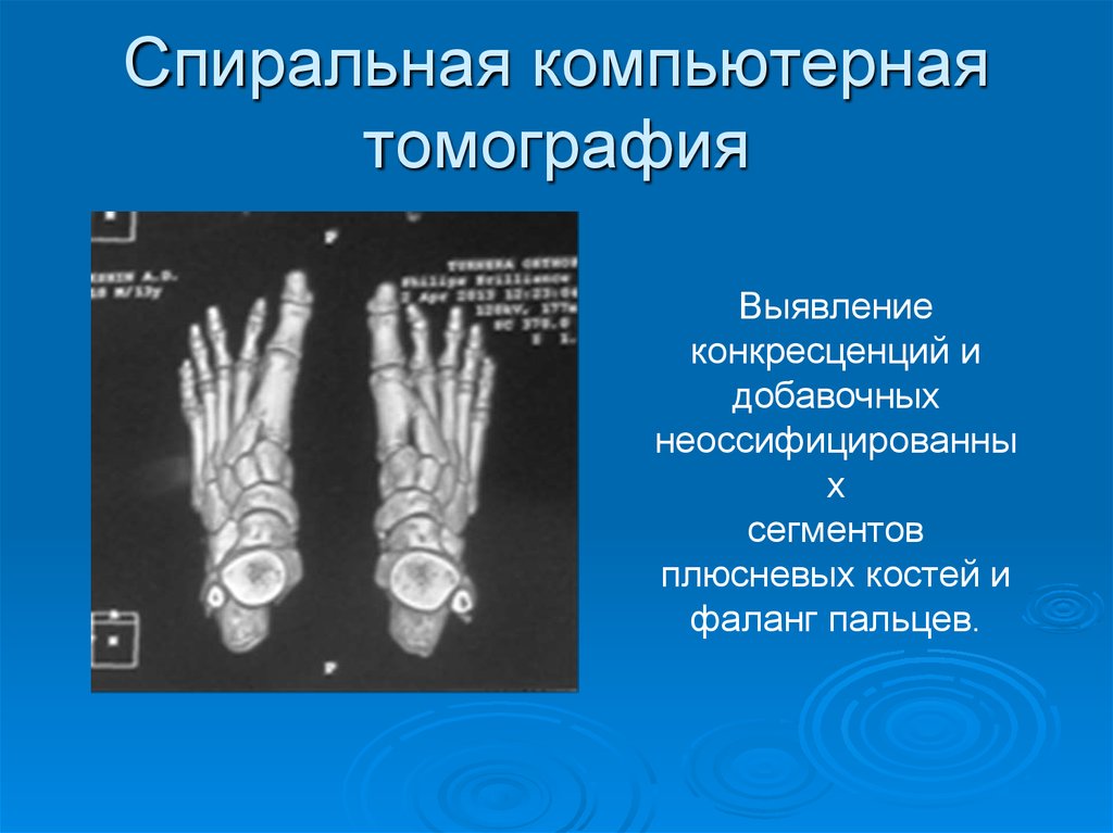 Спиральная компьютерная томография