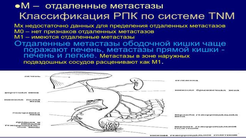 Рак ободочной кишки презентация