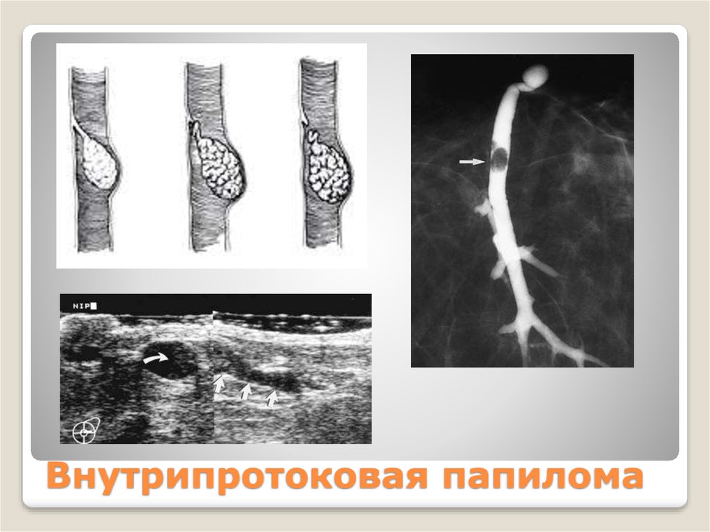 Внутрипротоковое молочной. Внутрипротоковая папиллома дуктография. Внутрипротоковая папиллома молочной железы дуктография. Внутрипротоковая папиллома молочной железы мрт. Внутрипротоковая папиллома молочной железы микропрепарат.