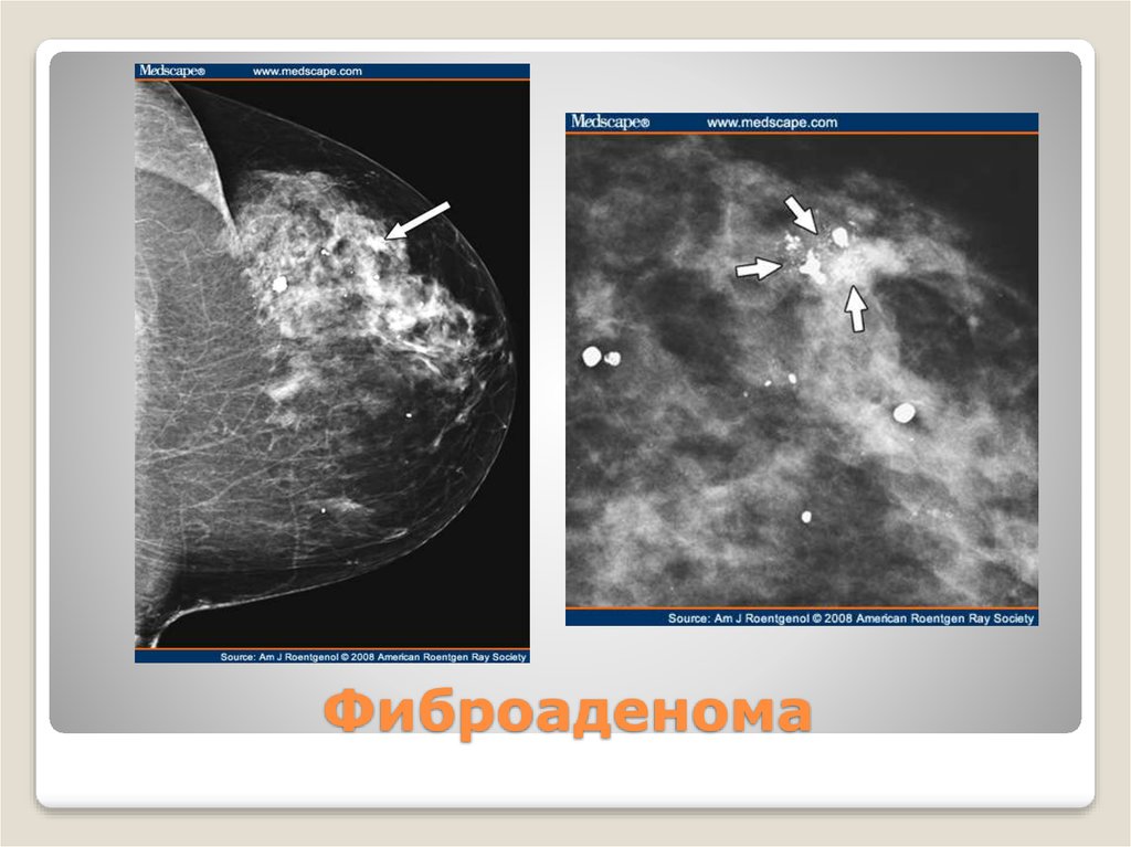 Фиброаденоматоз молочной железы что это такое. Листовидная фиброаденома на маммографии. Листовидная фиброаденома молочной железы мрт. Листовидная фиброаденома рентген. Фиброаденома доброкачественная опухоль молочной железы УЗИ.
