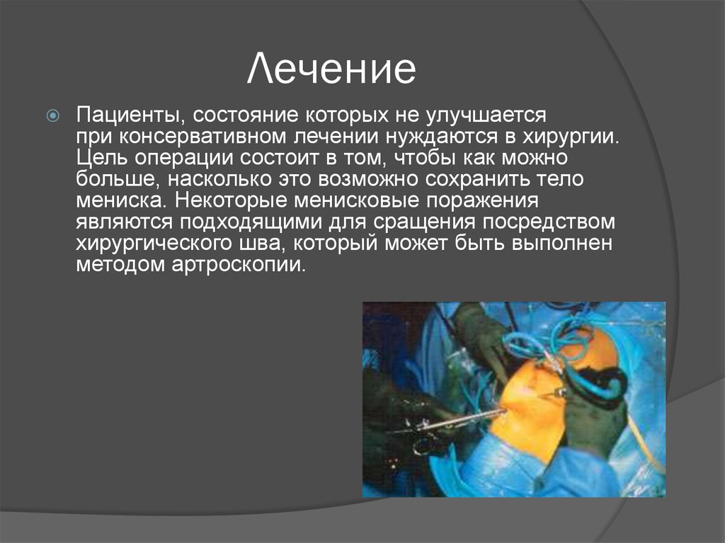 Операции состоит в том. Болезнь Гоффа коленного сустава операция. Разрыв мениска и болезнь Гоффа. Болезнь Гоффа артроскопия. Тело Гоффа коленного сустава.