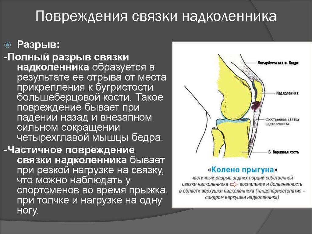 Повреждение коленной связки. Разрыв связки надколенника рентген. Отрыв медиального удерживателя надколенника. Разрыв собственной связки надколенника рентген. Повреждение медиального удерживателя надколенника 2 степени.