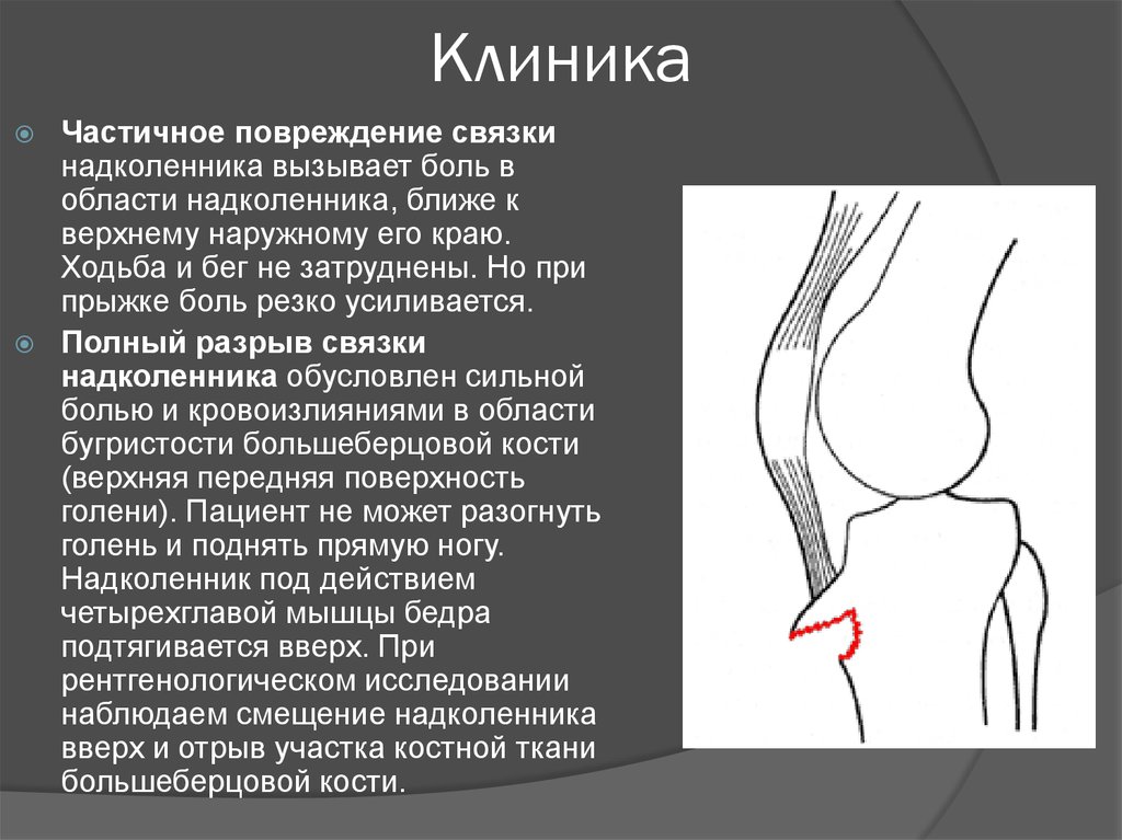 Повреждение коленной связки симптомы. Оссификация связки надколенника. Окостенение связки надколенника. Повреждение связки надколенника симптомы. Тендинит надколенника рентген.