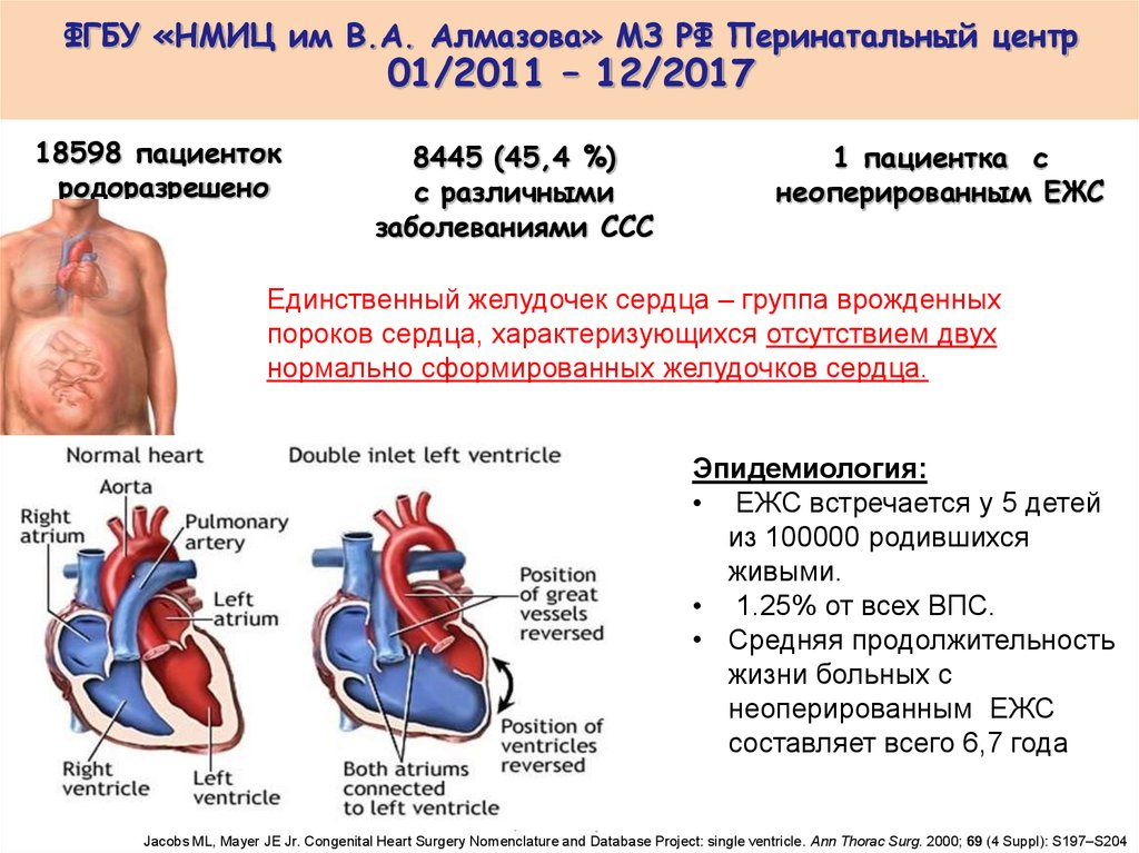 Порок сердца продолжительность жизни. Двуприточный единственный желудочек сердца. ВПС единственный желудочек. Единый желудочек сердца. Врожденный порок сердца единственный желудочек сердца.