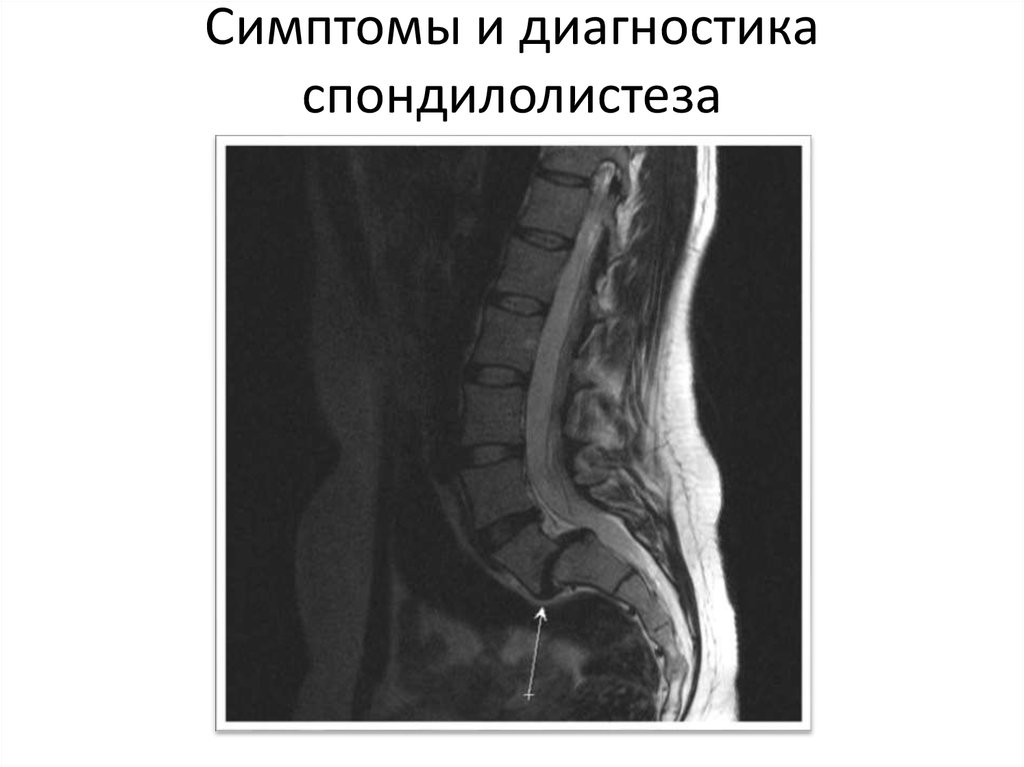 Смещение позвонков поясничного отдела. Смещение позвонков l5 s1. Смещение позвонка l5 кпереди. Спондилолиз l5 мрт. Спондилолистез позвоночника l5.