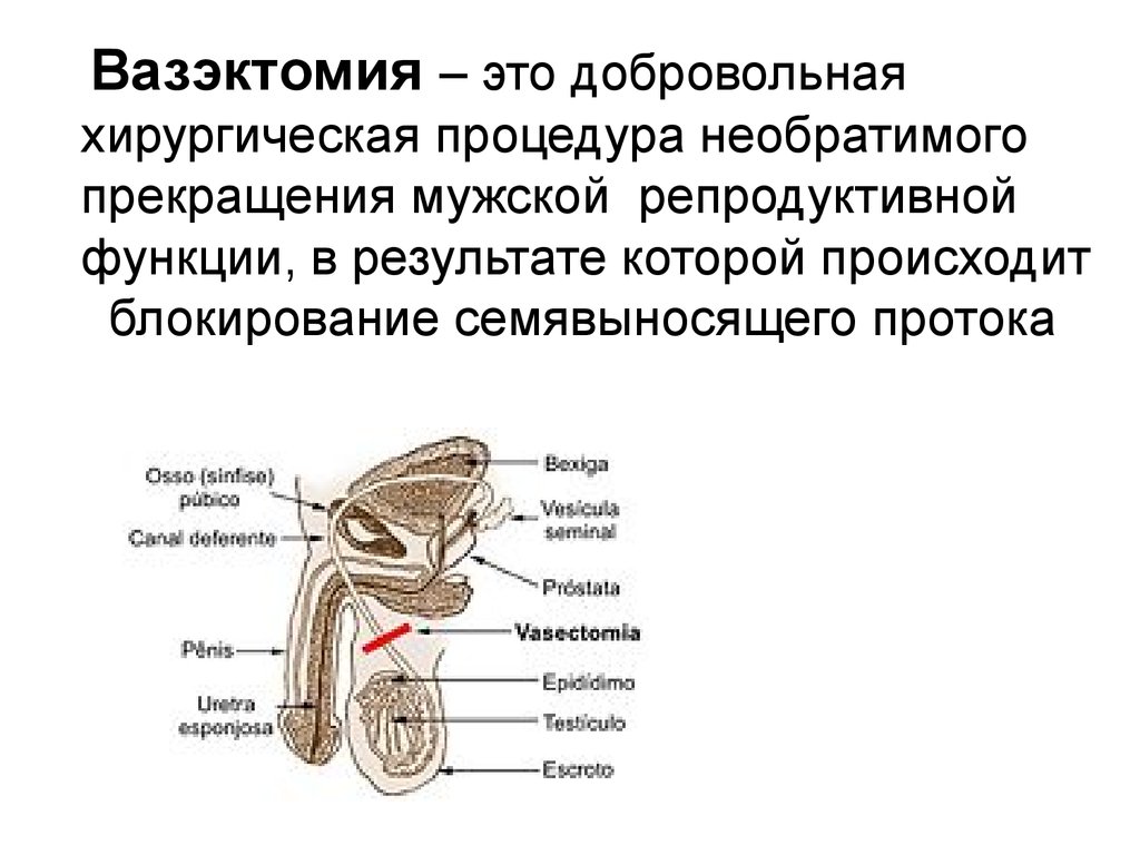 Вазэктомия что это. Семявыносящий проток функции. Вазэктомия схема операции. Вазэктомия — перерезание семявыносящих протоков..