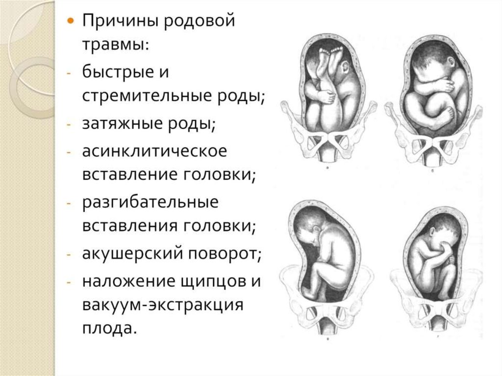 Расположение плода по передней стенке что это