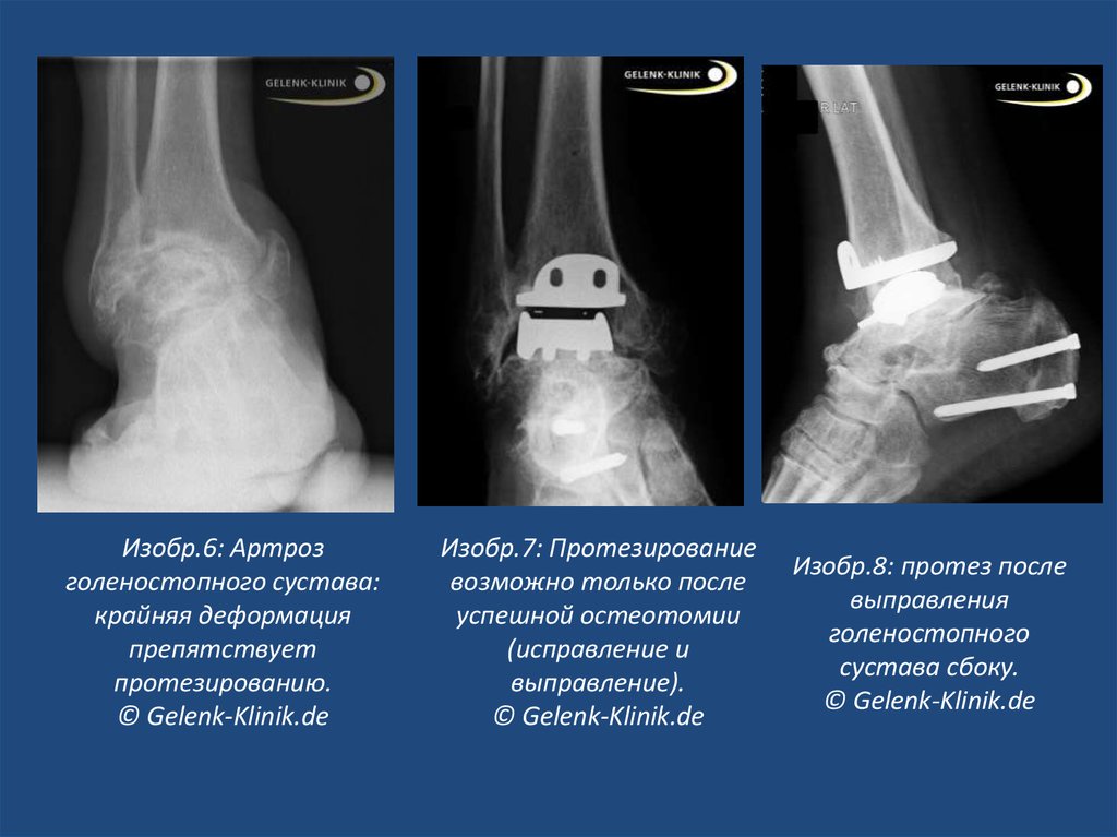 Суставная щель голеностопного сустава. Артродез голеностопного сустава рентген описание. Артроз голеностопного сустава рентген. Анкилоз сустава голеностопного сустава. Артроз голеностопного сустава рентген стадии.