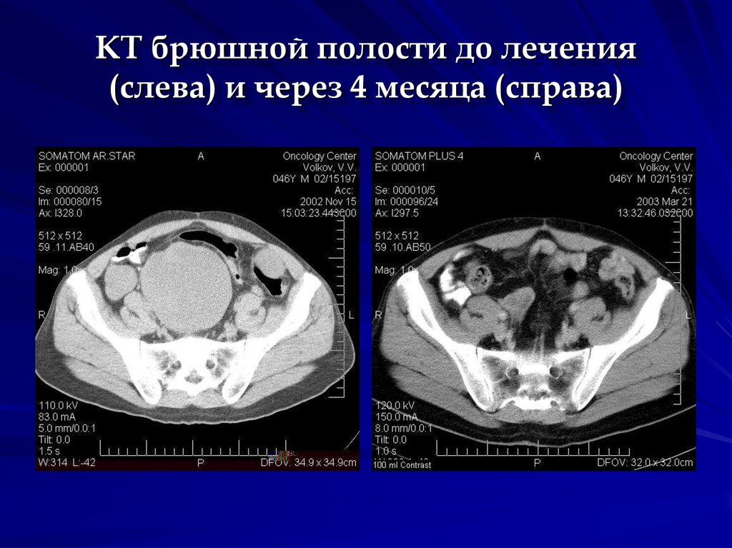 Рак брюшной. Новообразование брюшной полости. Новообразование в органах брюшной полости. Объемное образование брюшной полости. Опухоли органов брюшной полости.