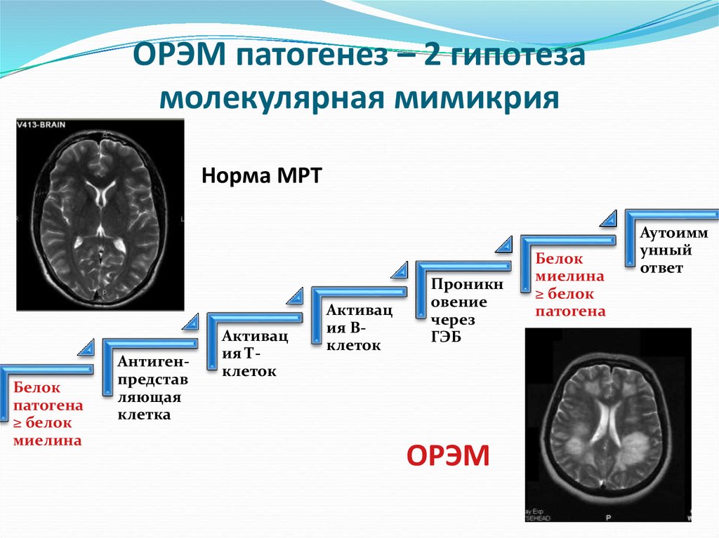 Рассеянный склероз патогенез схема