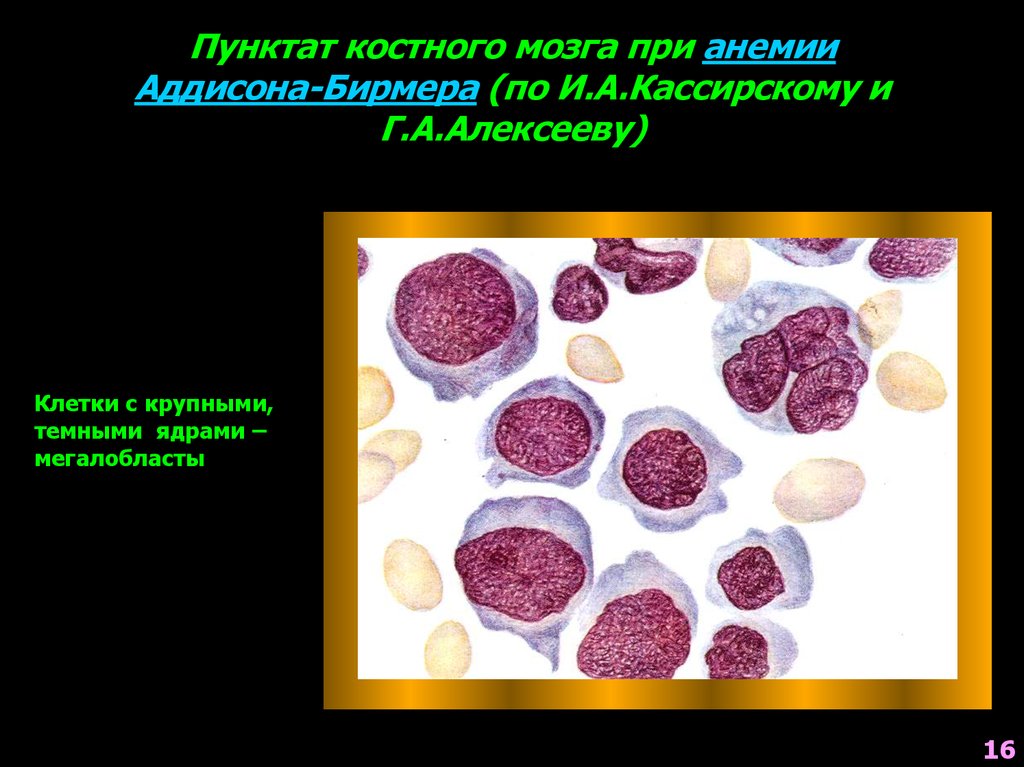 Результаты костного мозга. Пунктат костного мозга при анемии. Исследование пунктата костного мозга. Анемия Аддисона Бирмера.