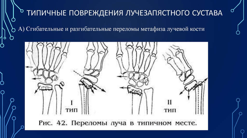 Перелом кисти карта вызова