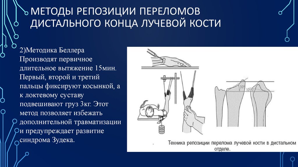 Перелом колеса и смита презентация