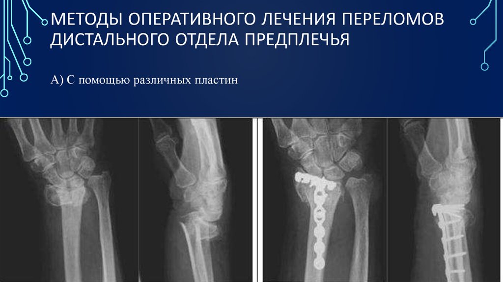 Сколько срастается предплечье. Перелом дистального метаэпифиза лучевой кости. Остеосинтез перелома лучевой кости. Интрамедуллярный остеосинтез лучевой кости. Остеосинтез ДМЭ лучевой кости.