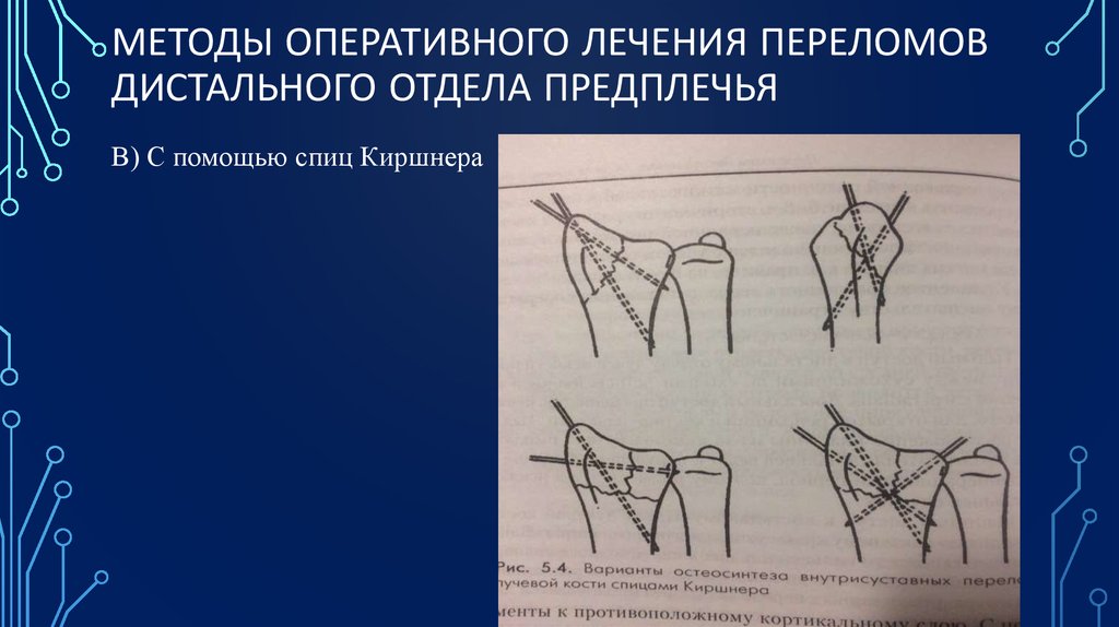 Оперативный метод лечения переломов. Переломы дистального отдела предплечья.