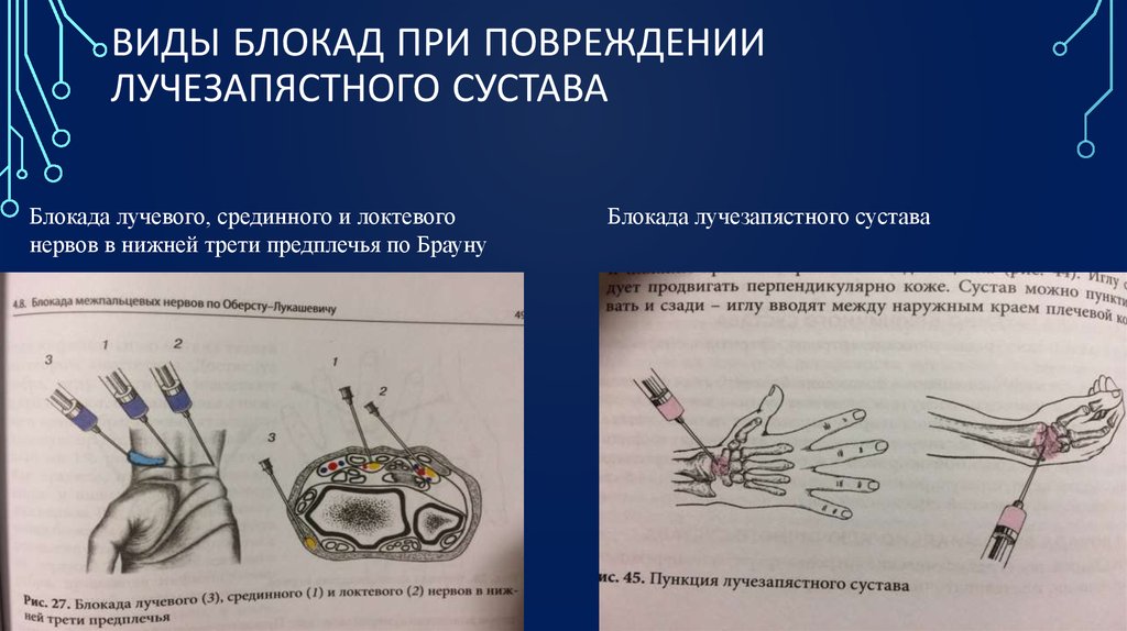 Блокада предплечья. Блокада локтевого лучевого и срединного нервов. Пункция лучезапястного сустава схема. Проводниковая анестезия локтевого и лучевого нерва.