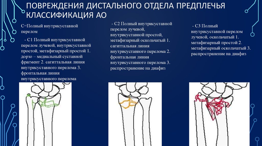 Перелом дистального метаэпифиза лучевой кости. Классификация переломов костей предплечья АО. Переломы лучевой кости классификация. Классификация АО переломов лучевой кости. Перелом локтевой кости классификация АО.