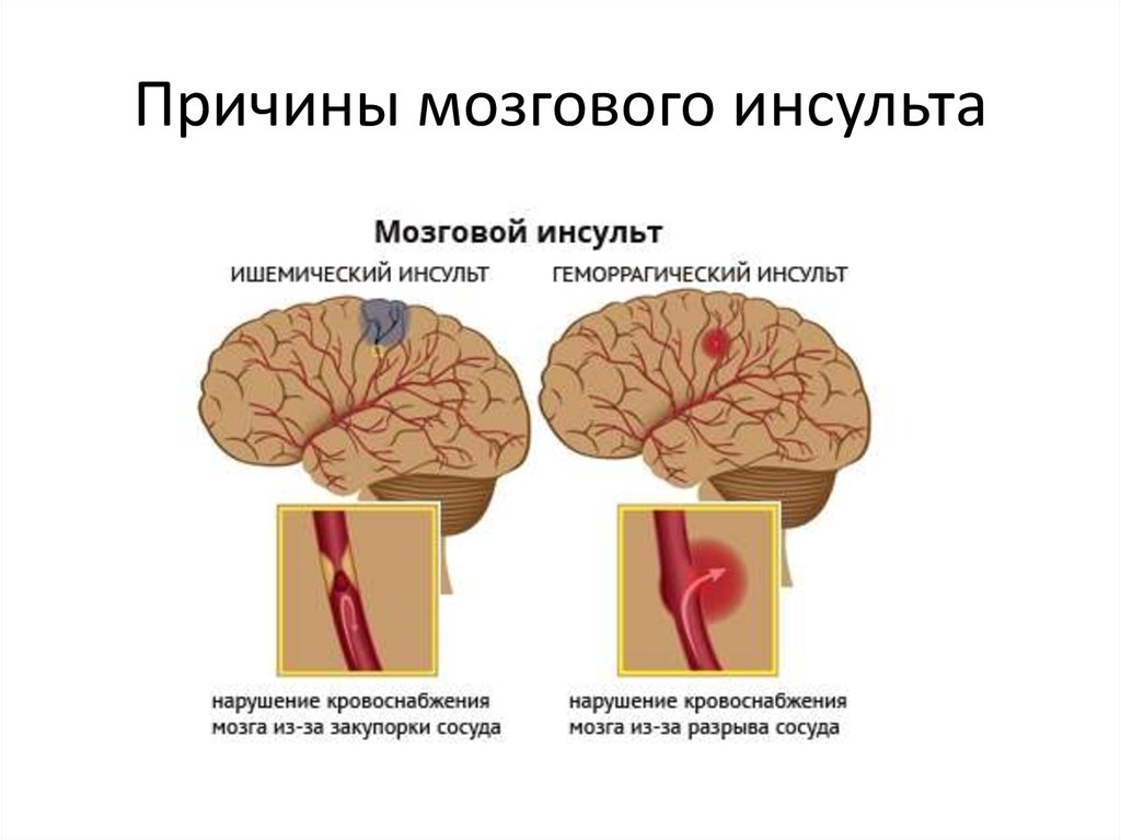 Может быть инсульт мозгов. Ишемический инсульт общемозговые симптомы. Ишемический инсульт в коре головного мозга. Основные признаки ишемического инсульта.